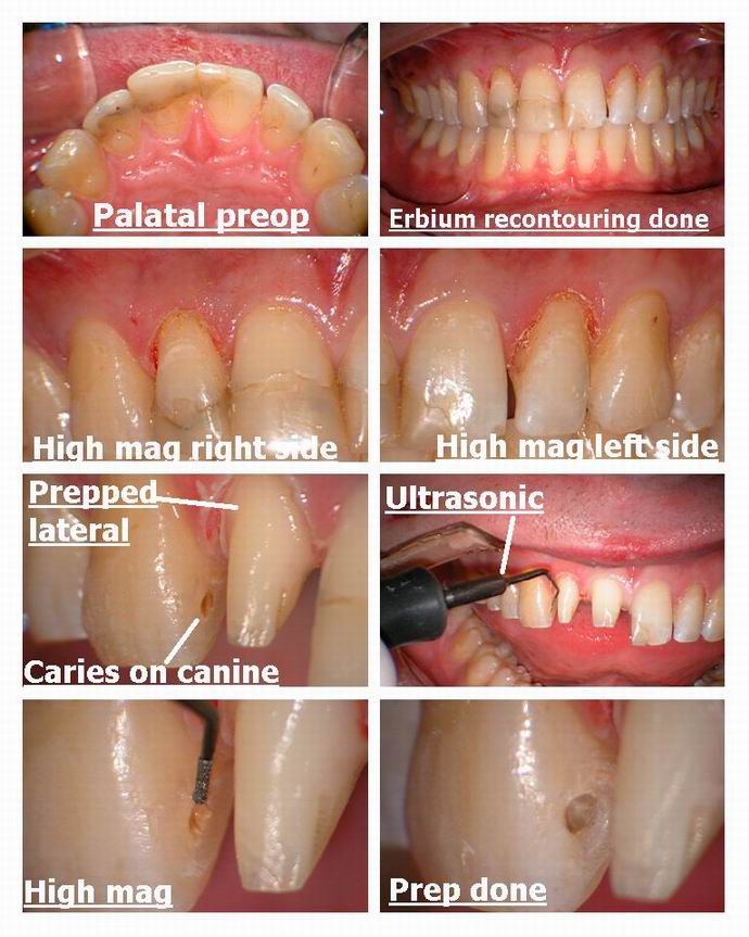 Resize of Laser recontouring with erbium pg 2.jpg